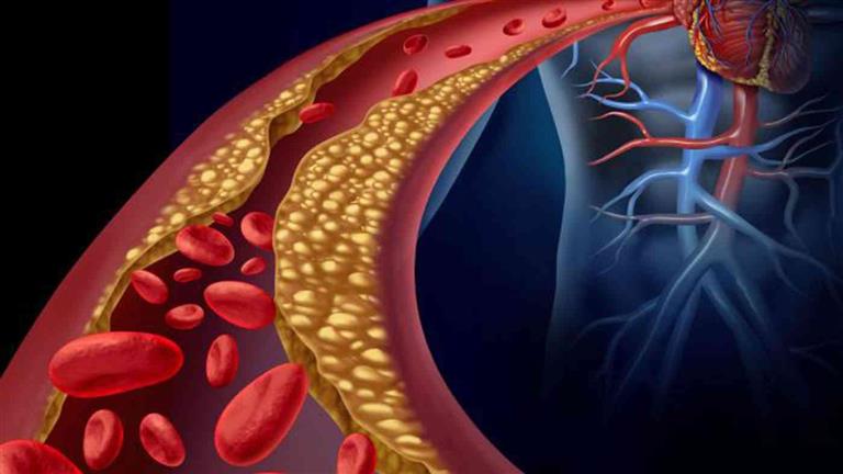 5 أشياء صباحية ترفع من مستوى الكوليسترول بالدم.. واعراض تكشف الإصابة 