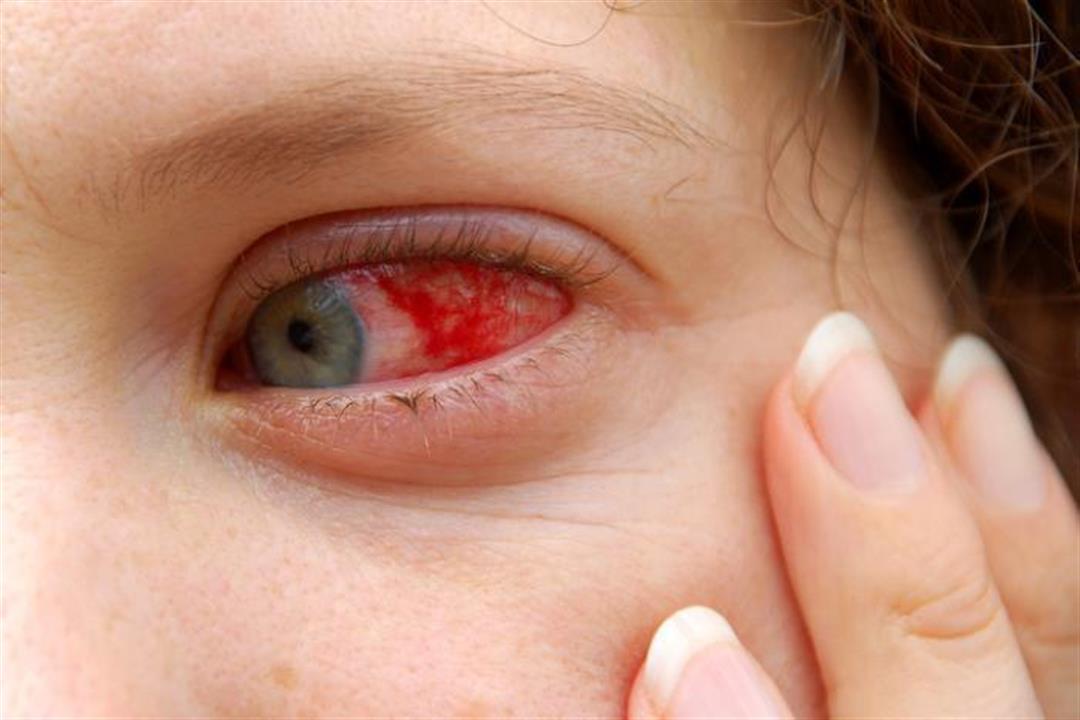 احذر- احمرار العين المفاجئ علامة على هذه الأمراض