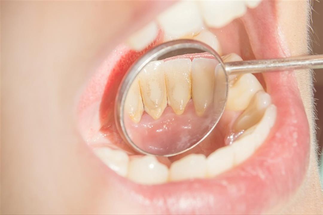 في 8 خطوات- دليلك لمنع تكوين جير الأسنان