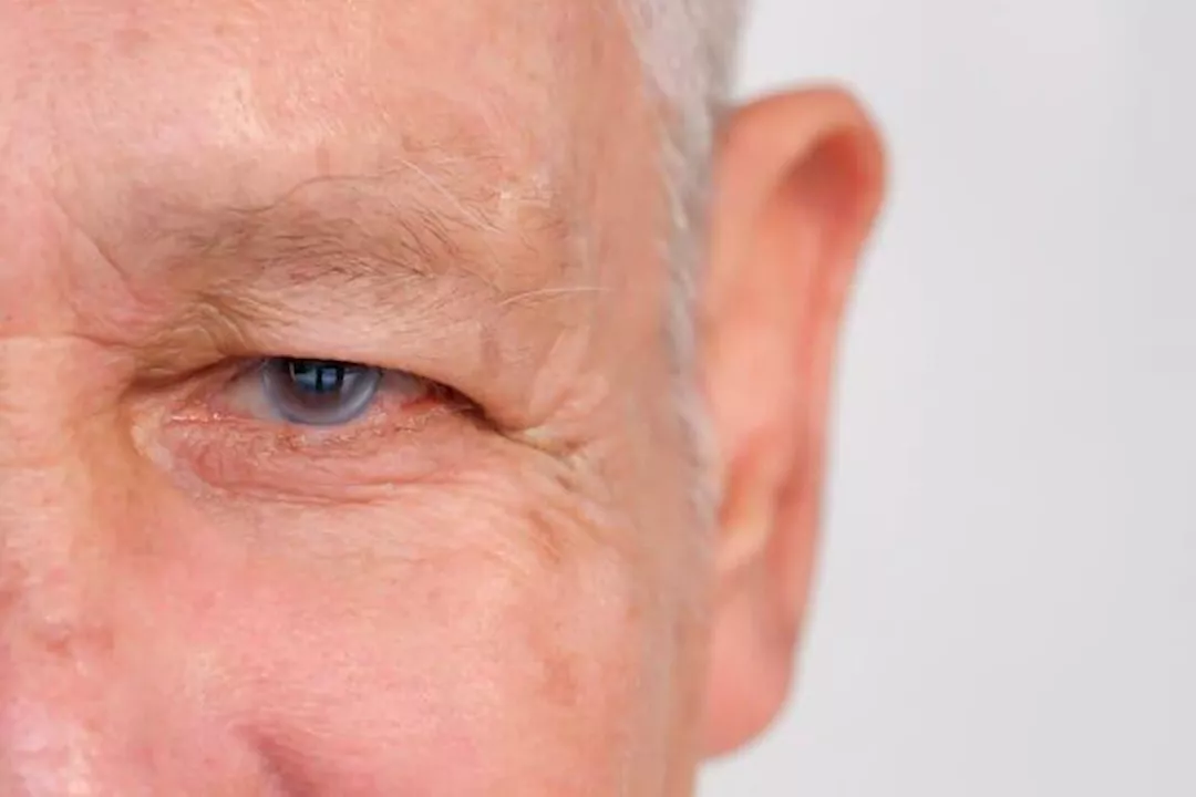 طبيب يحذر: ارتفاع ضغط العين أهم أسباب الإصابة بالجلوكوما