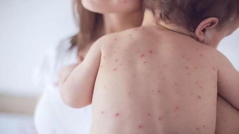 تفشي الحصبة ينحسر في أميركا.. وميشيغان وبنسلفانيا خاليتان رسميًا من ال