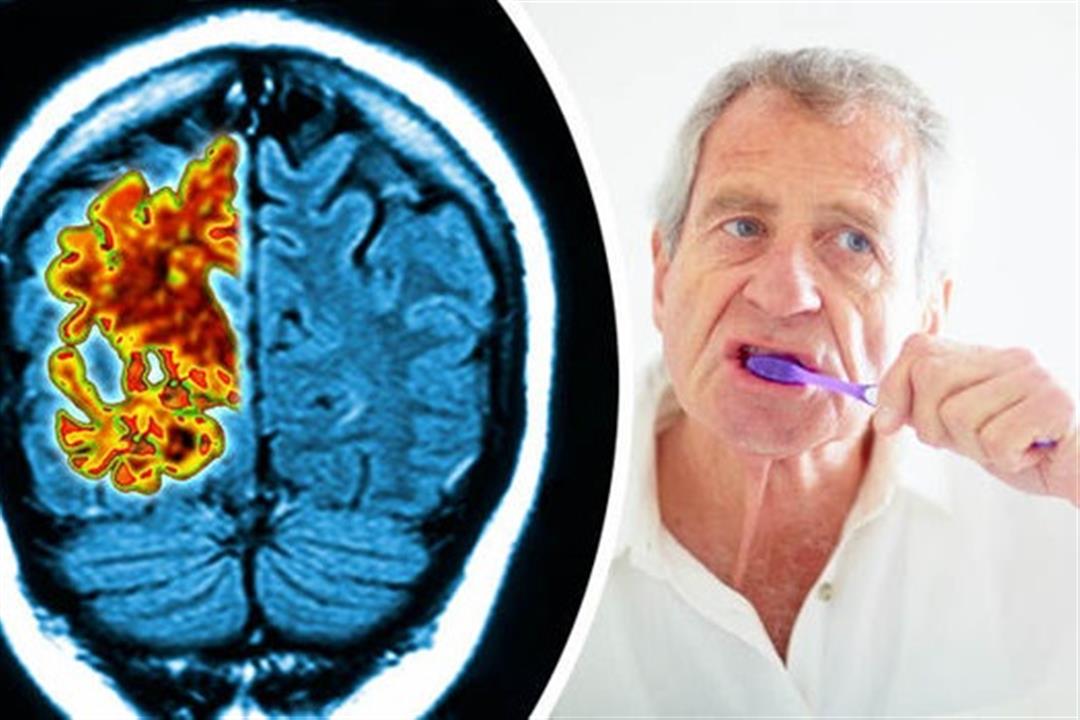 العقل السليم في الفم النظيف- غسل الأسنان يحمي مخك من مرض خطير