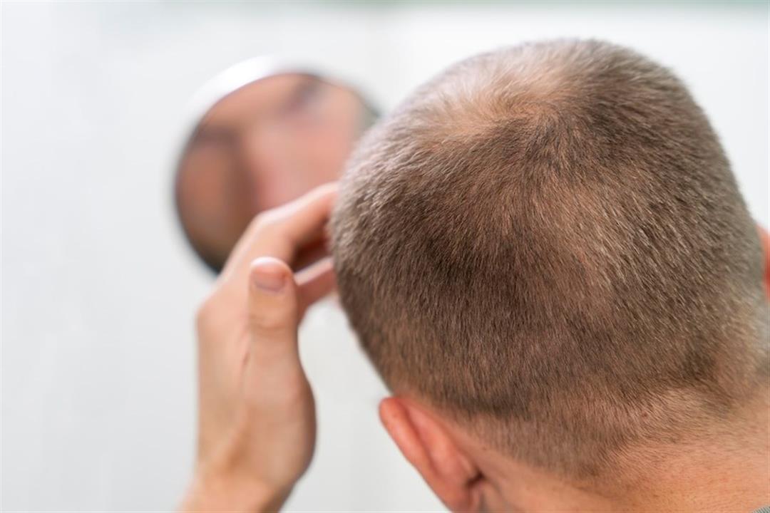 هل يمكن أن يتساقط الشعر بعد الزراعة؟- طبيب يجيب "فيديو"