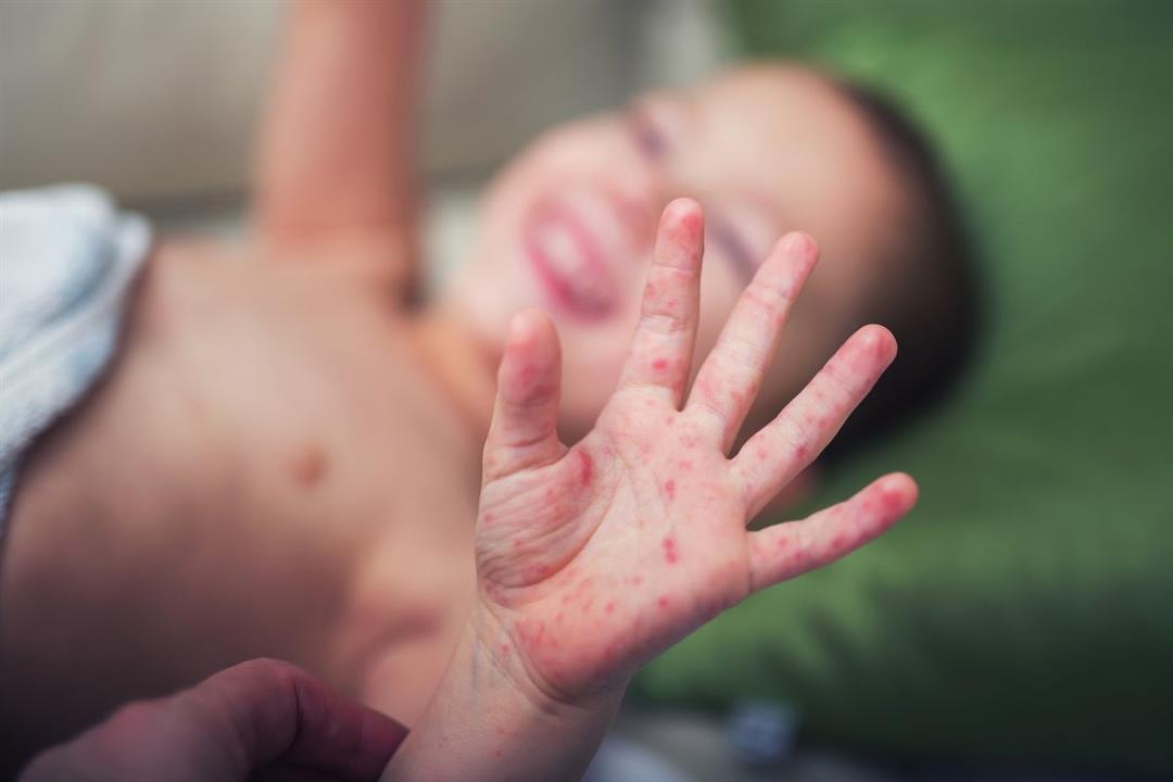 س & ج- دليل شامل عن فيروس اليد والقدم والفم عند الأطفال
