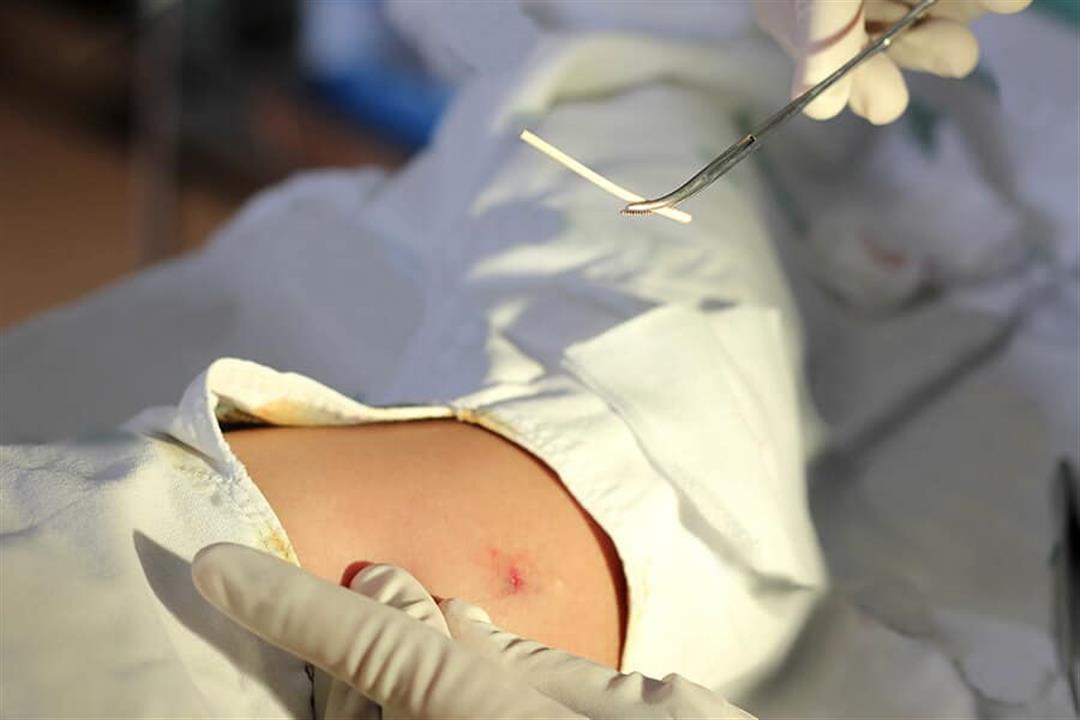 nexplanon-birth-control-removal