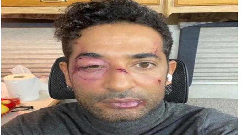 Amr Saad Shares Shocking Photo of Bruised Face on Instagram: Fans Express Concern and Speculation