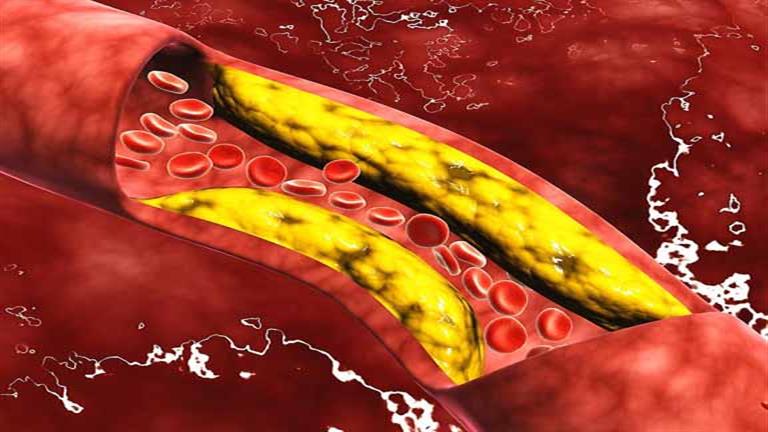 علامة تكشف ارتفاع الكوليسترول بالدم… وهذه طرق علاجه