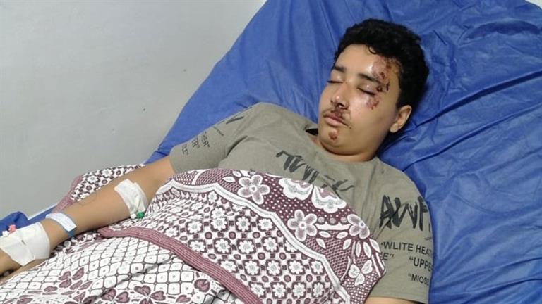 "تركيب مسمار نخاعي للفخذ".. ننشر تفاصيل إصابة الطالب "زياد" ضحية زميلته في الشرقية