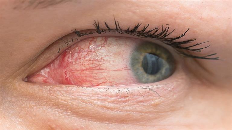ما الفئات الأكثر عرضة للإصابة بجفاف العين؟