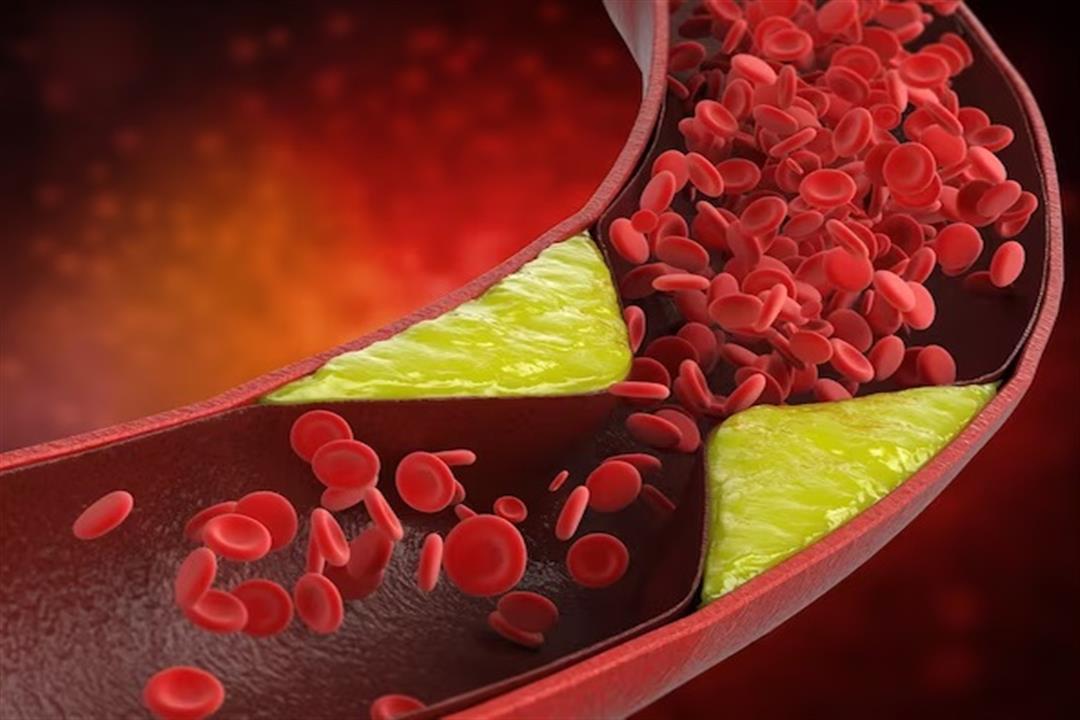 علامات بالجلد تكشف ارتفاع الكوليسترول بالدم- احذرها