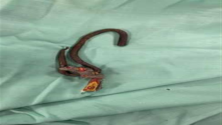 بالصور- استخراج سيخ حديد من حلق طفلة بمستشفى جامعة أسوان