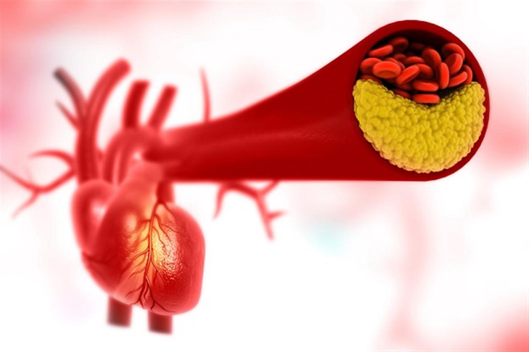 ضيق الشرايين- هل يمكن العلاج دون جراحة؟