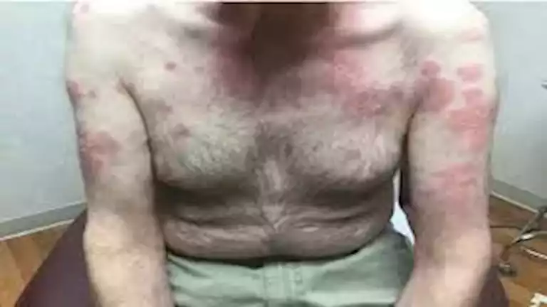 مرض فيكساس