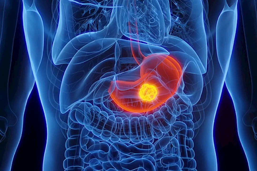 سرطان المعدة