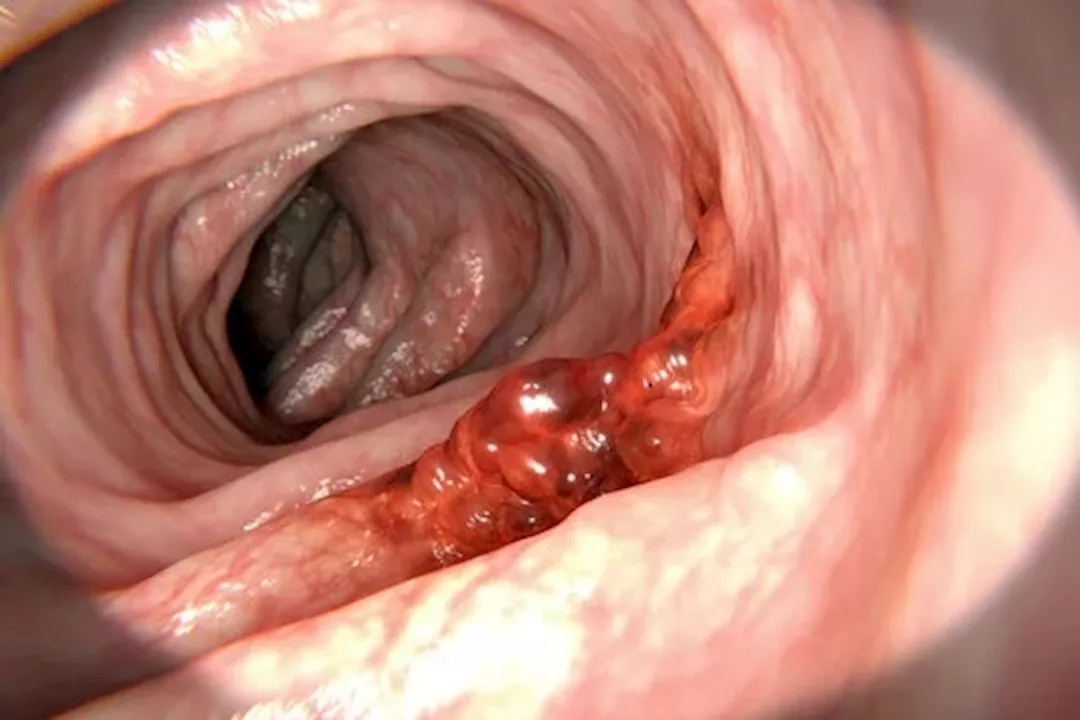 لحماية قولونك من السرطان- 6 وجبات خفيفة تناولها يوميًا