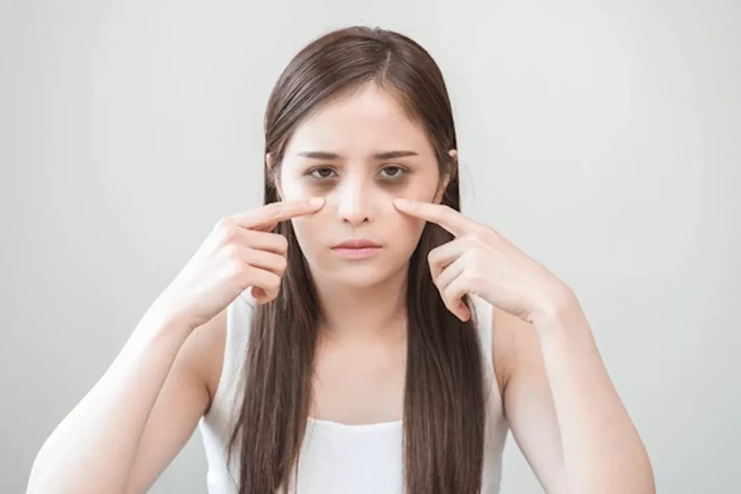 الهالات السوداء