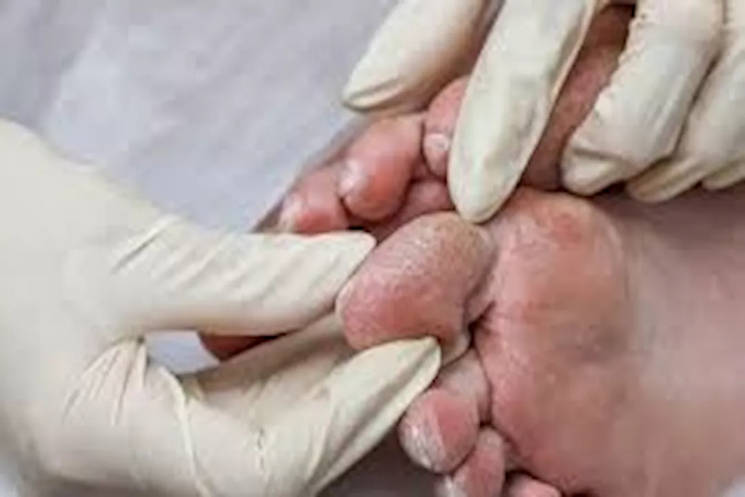 القدم السكري