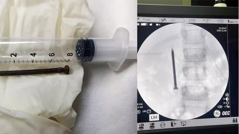 في 20 دقيقة.. فريق طبي يستخرج مسمارًا حادًا من أمعاء طفلة بالمنوفية