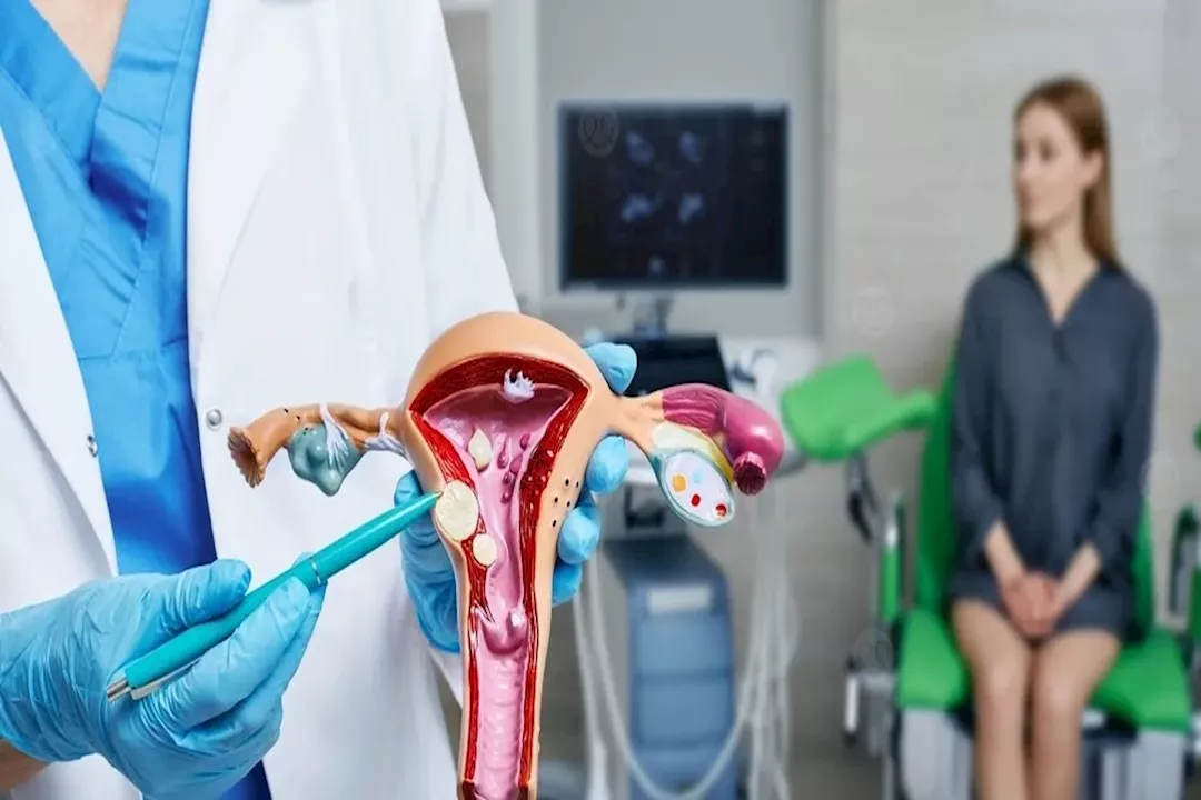 الأورام الليفية