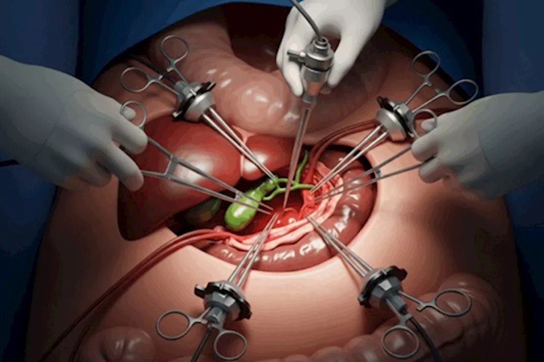 اسئتصال المرارة