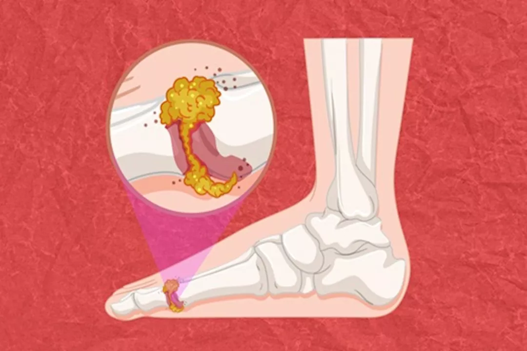 تراكم حمض اليوريك حول الإصبع الكبير بالقدم