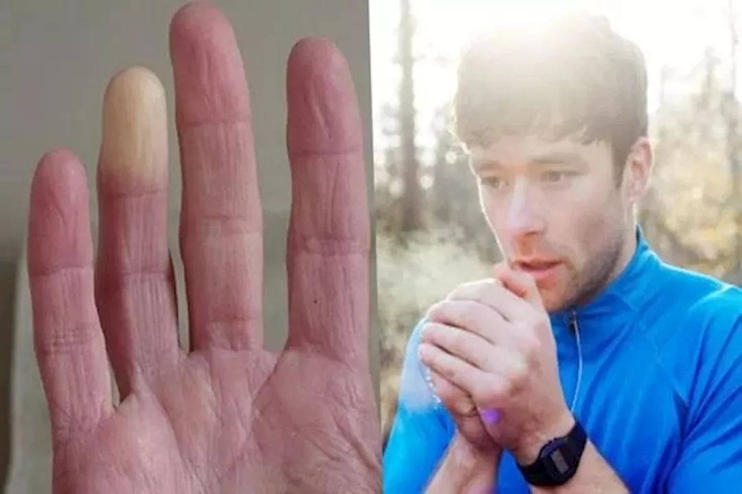 متلازمة الرينود