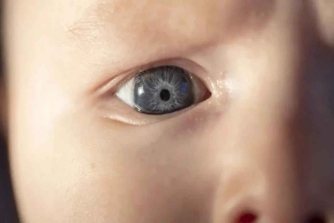 المياه البيضاء