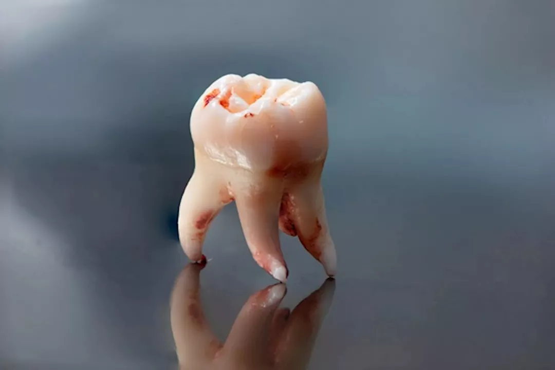 خلع ضرس العقل