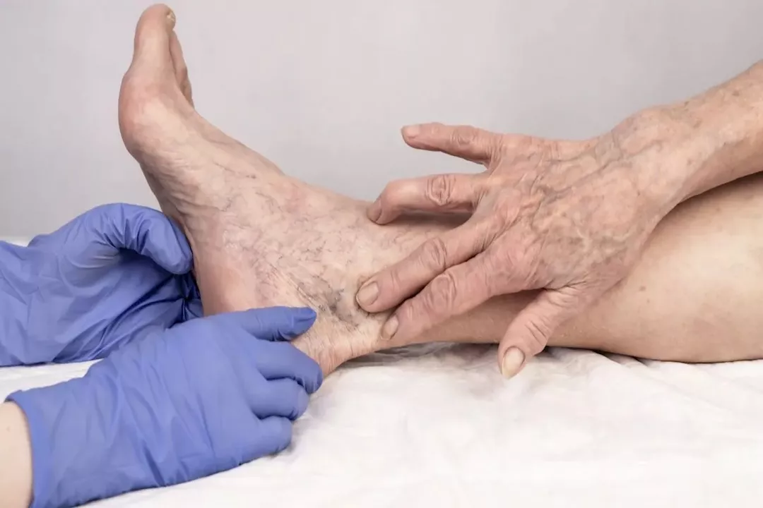 دوالي الساقين.. متى تتحول إلى جلطة؟