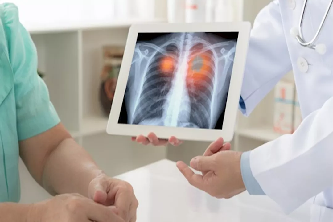 سرطان الرئة