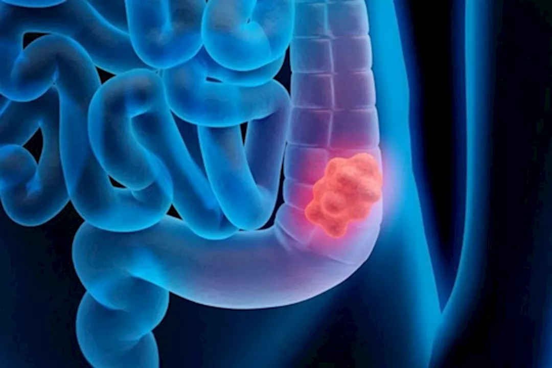 سرطان القولون