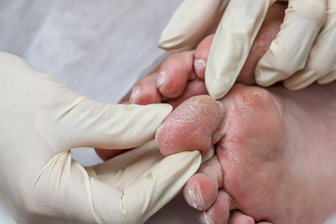 حسام موافي يوضح طرق الوقاية من مضاعفات القدم السكري