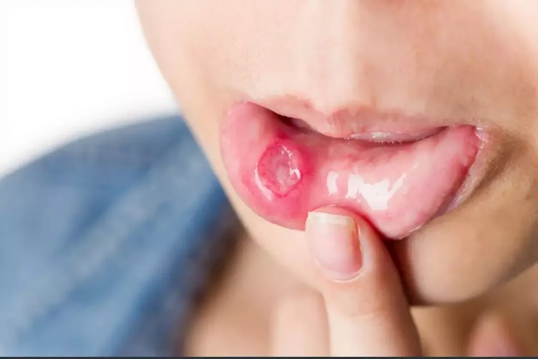 تقرحات الفم.. متى تشير إلى مرض خطير؟