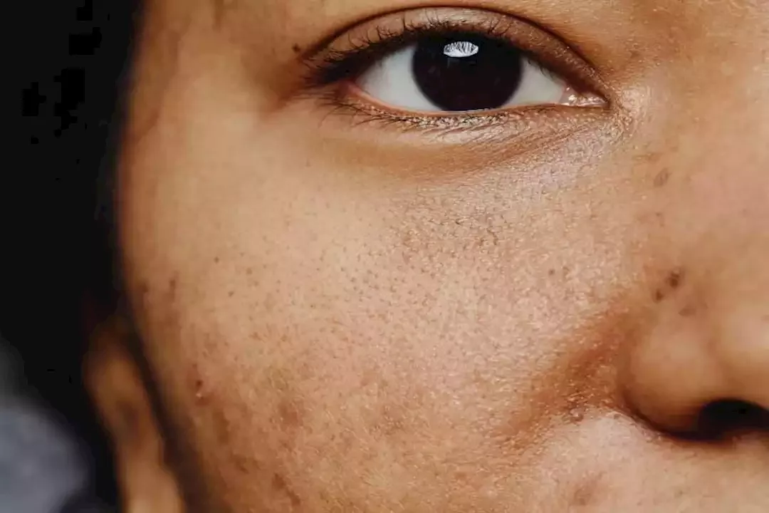 أيهما أفضل لإزالة التصبغات.. الأجهزة الطبية أم الكريمات الموضعية؟