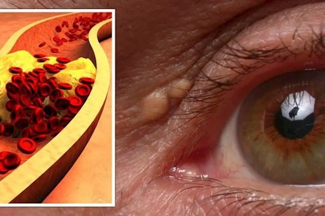 ماذا يحدث لعينيك عند ارتفاع الكوليسترول بالدم؟ 