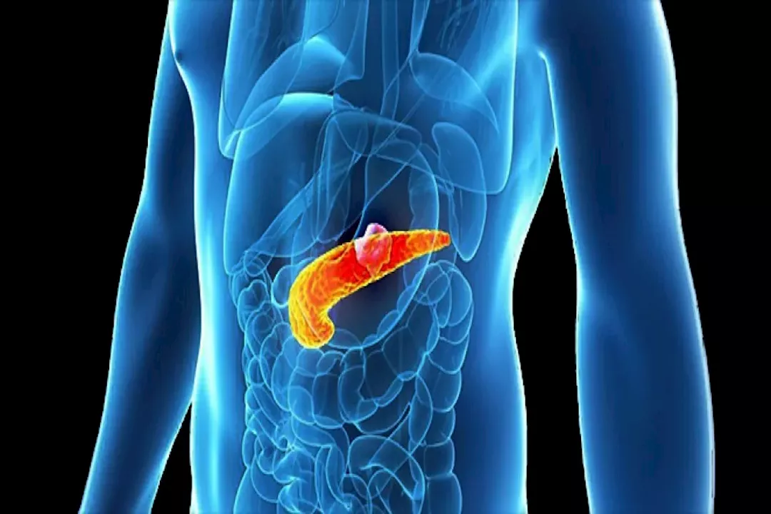 تكيسات البنكرياس.. كيف تحمي نفسك منها؟ 