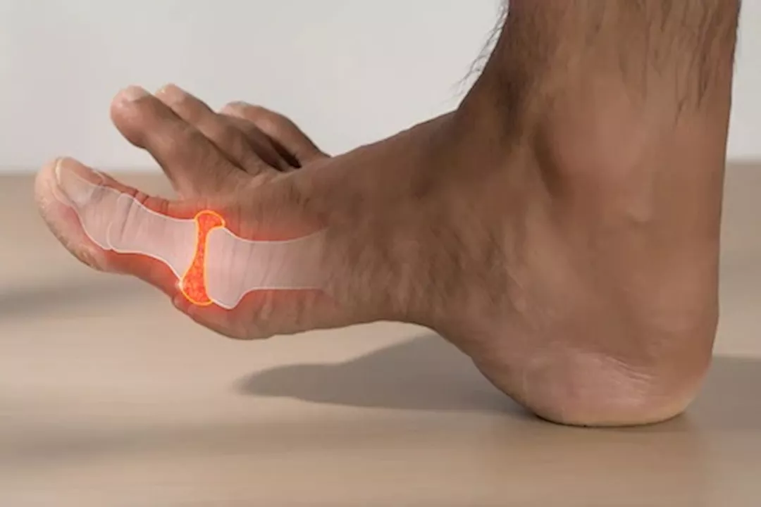 ارتفاع حمض اليوريك