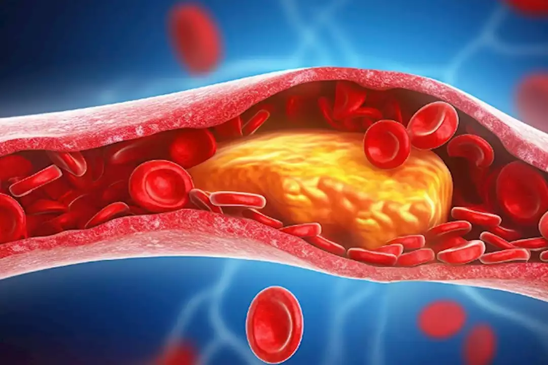 ارتفاع الكوليسترول