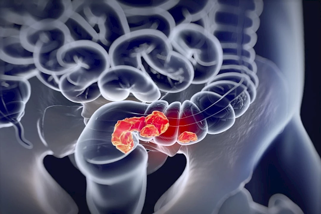 علامة على سرطان القولون- 4 أعراض تستدعي زيارة الطبيب