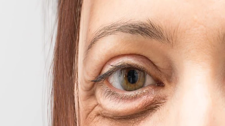 هل انتفاخ الجفون في الصباح مؤشر على مشكلات الكلى؟ 