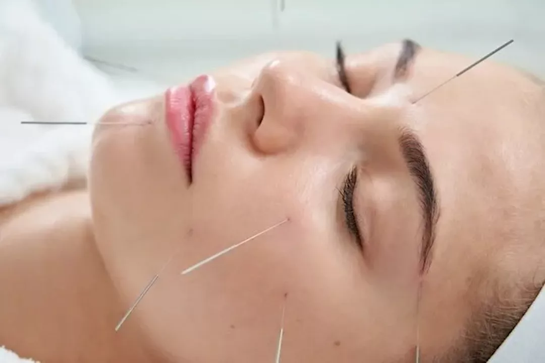 الوخز بالإبر