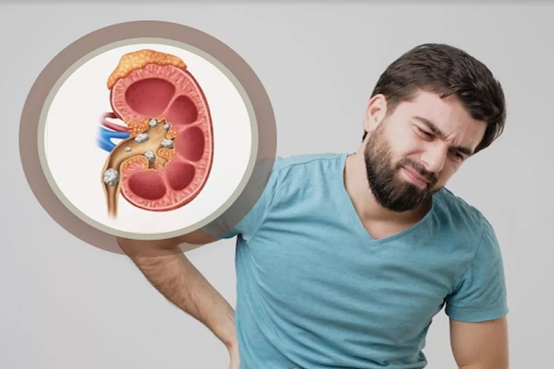 حصوات الكلى عند الرجال