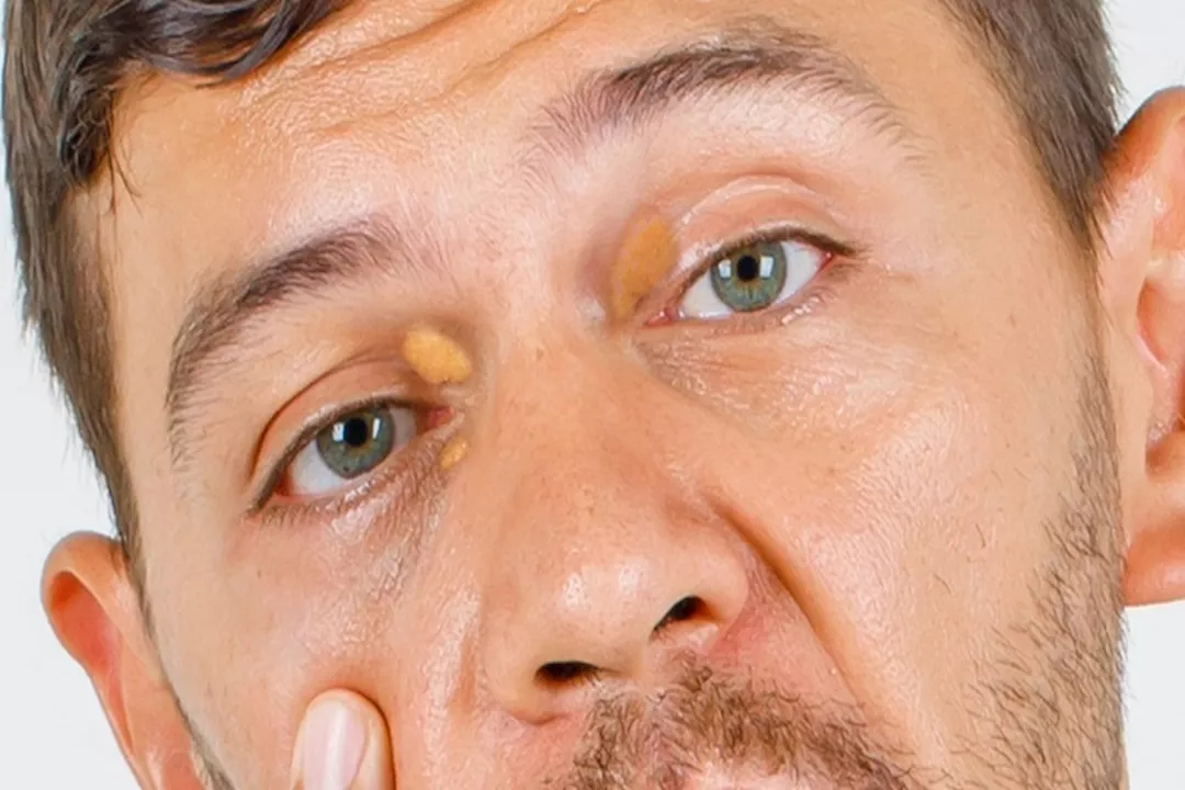 الفرق بين الزانثلازما والزانثوما