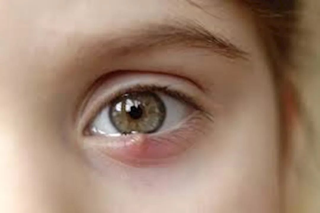 هل استخدام كمادات الشاي تعالج شعيرة العين؟