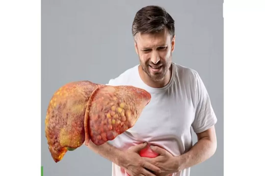 الكبد الدهني