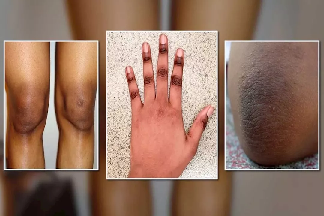 اسمرار المفاصل