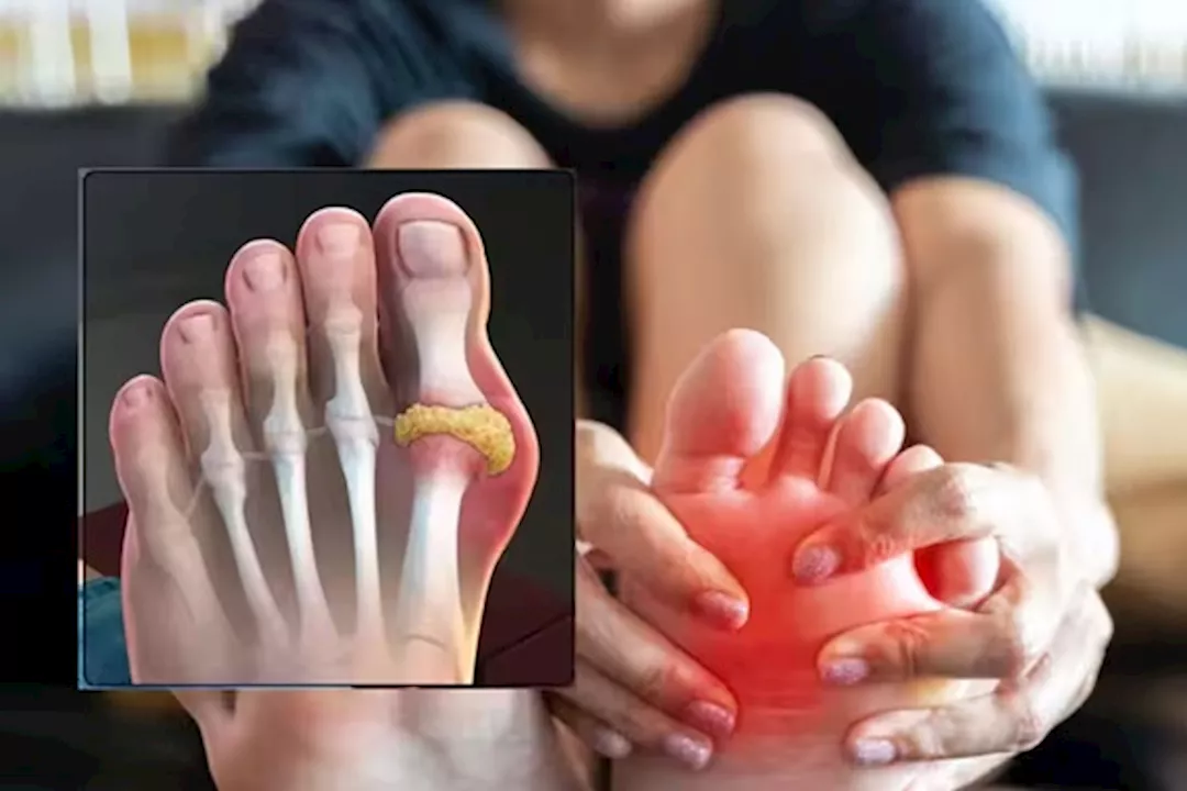 تراكم حمض اليوريك حول مفصل إصبع القدم الكبير