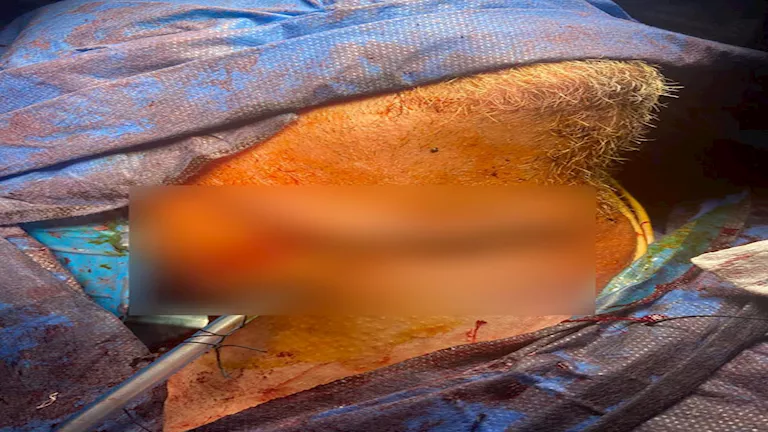 منشار كهربائي يخترق رقبة رجل وهكذا تدخل جراحو جامعة أسيوط لإنقاذه -صور