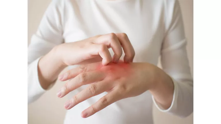 في الشتاء.. لماذا تتورم أصابع اليدين والقدمين وتصبح حمراء؟ 