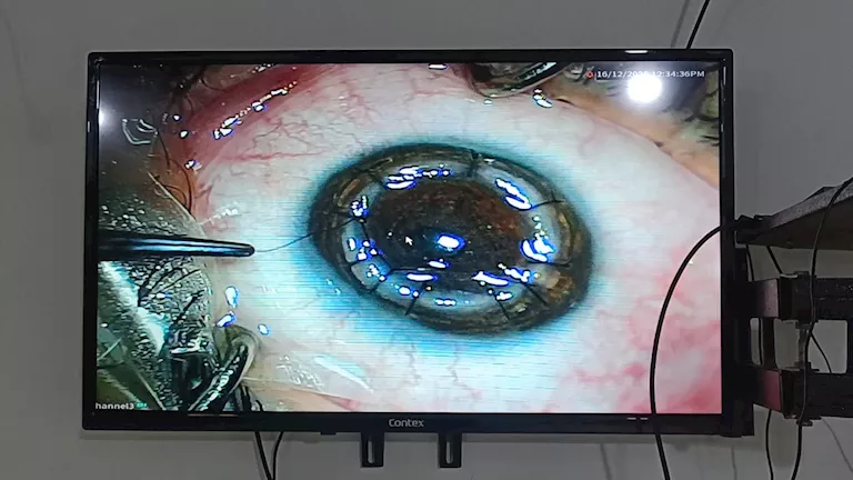 نجاح زراعة قرنية لشخص فاقد البصر بمستشفى رمد المنصورة (صور) 